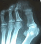 Bunion x-ray