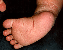 Types Of Clubfoot