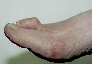Show Picture Of Hammer Toe